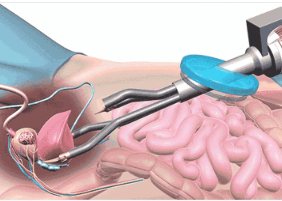 एसएमएस में रोबोट करेगा कैंसर जैसी बीमारियों का फ्री इलाज, 25-25 करोड़ की दो मशीनें खरीदीं